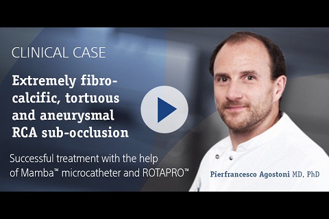 Extremely fibro-calcific, tortuous and aneurysmal RCA sub-occlusion